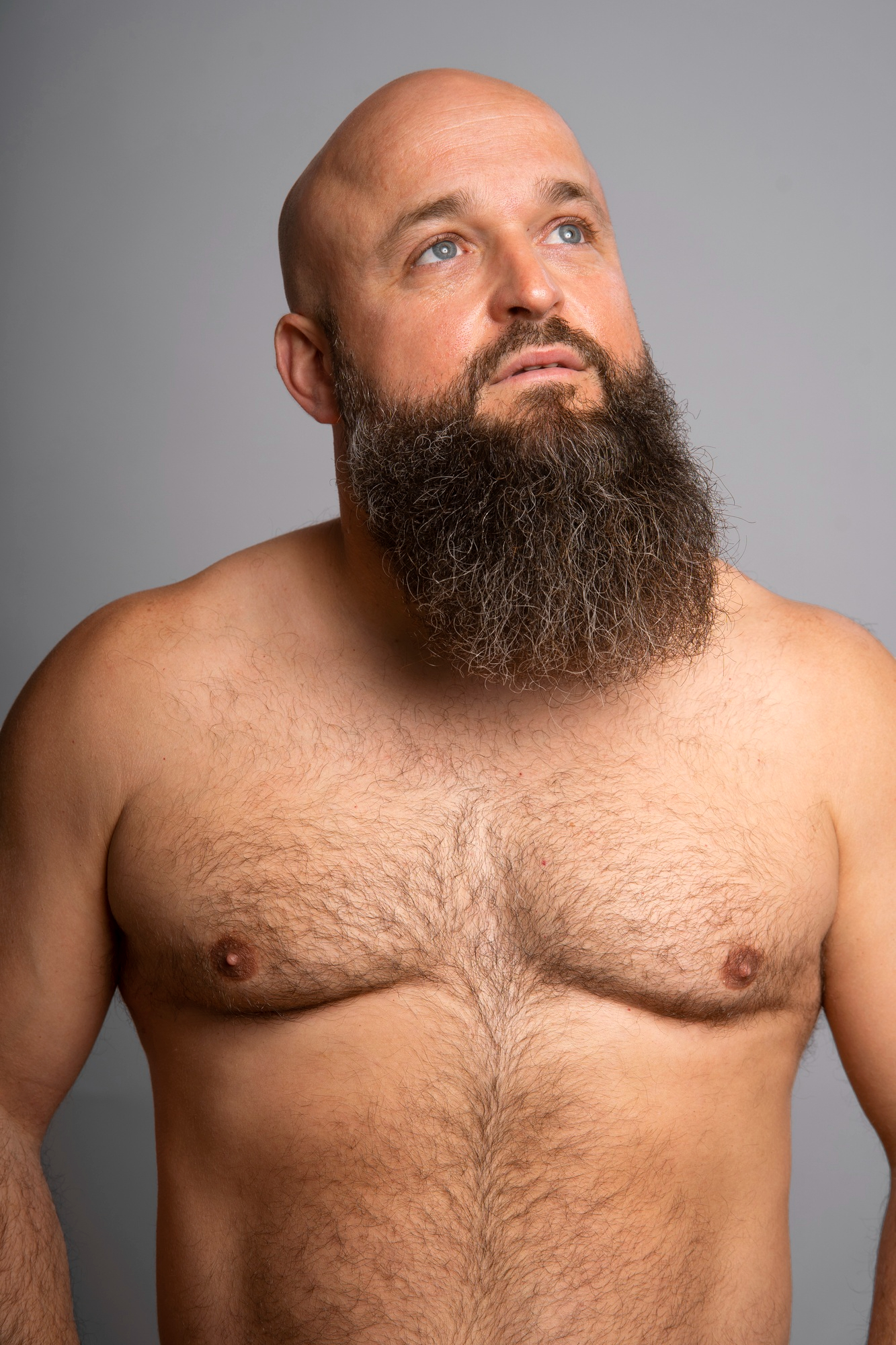 Gynecomastia