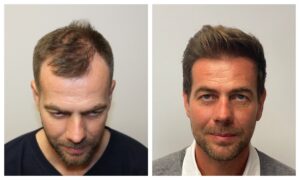 hair transplant result before after