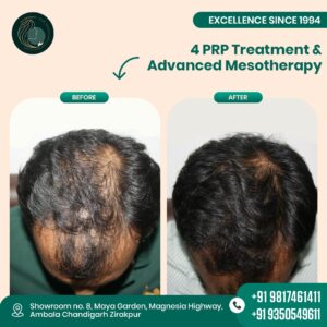 prp and advanced mesotherapy