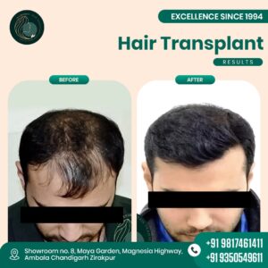 hair transplant near me