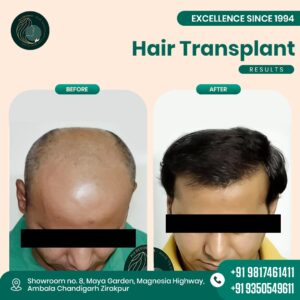 hair transplant punjab