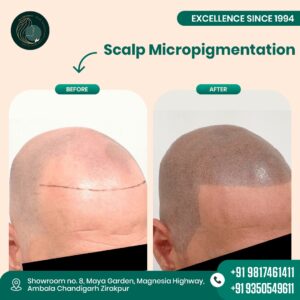 Scalp micropigmentation