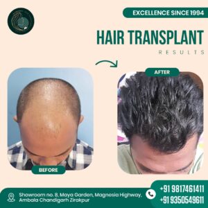 hair transplant results by Mahendra