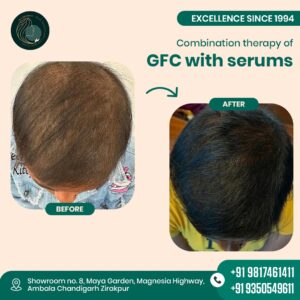 GFC for hair loss