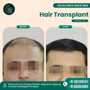 hair transplant mohali