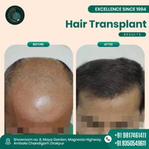 hair transplant chandigarh