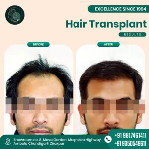hair transplant zirakpur