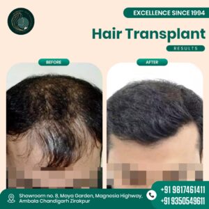 hair transplant before after