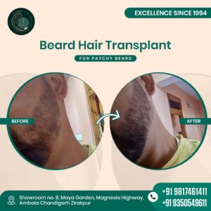beard hair transplant