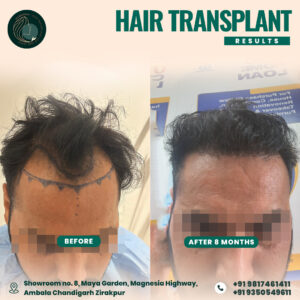 hair transplant result