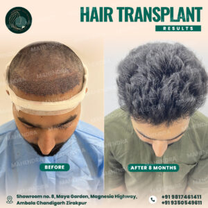 hair transplant result latest