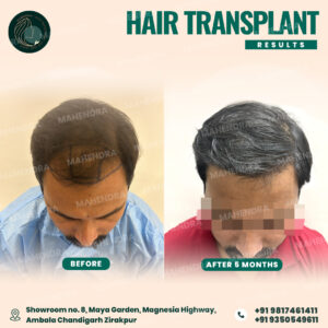 hair transplant result