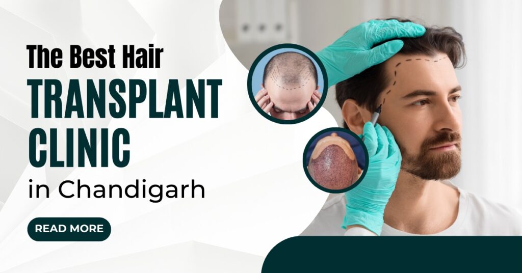Best Hair Transplant Clinic in Chandigarh