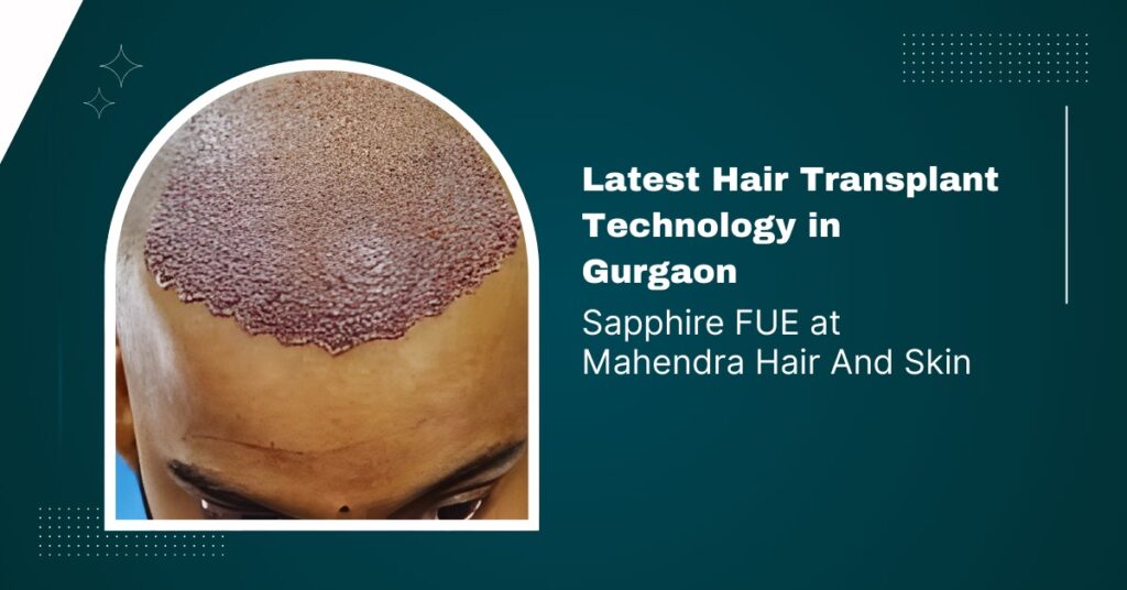 Latest Hair Transplant Technology in Gurgaon